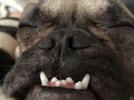 underbite