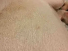 Tiny Bumps on Skin