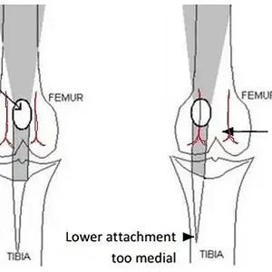 Patella.jpg